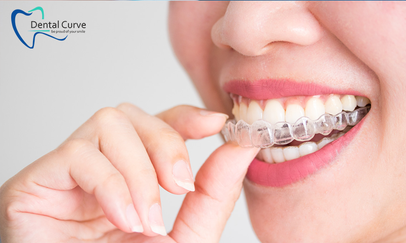 most affordable invisible braces